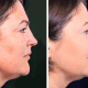 Como Usar Fotos de Antes e Depois para Atrair Clientes na Estética